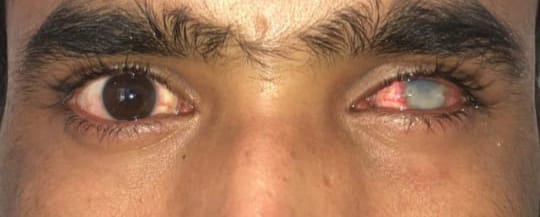 Pthisical Eye Before